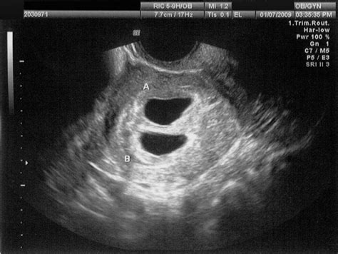 twin dating ultrasound